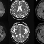 You're likely already infected with a brain-eating virus you've never heard of