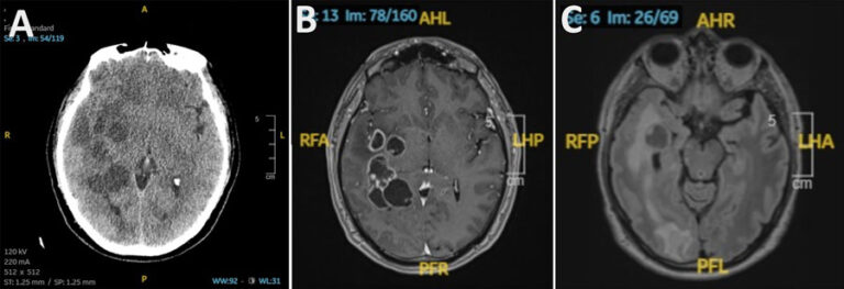 Doctors suspected man had brain cancer. He actually had worms.