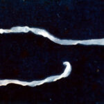Surprised doctors find 10-inch worm in man's groin during elective surgery