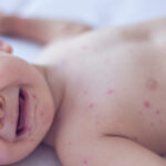 Measles killed 6-week-old baby, coroner confirms after RFK Jr. disputed deaths